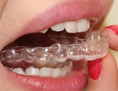 braces