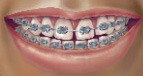 braces1