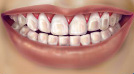 braces2