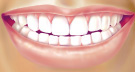 braces3