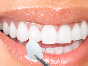 clear-braces-alternatives-porcelain-veneers